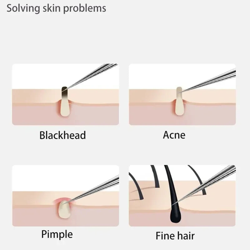 1/11Pcs Acne Pimples Blackhead Remover