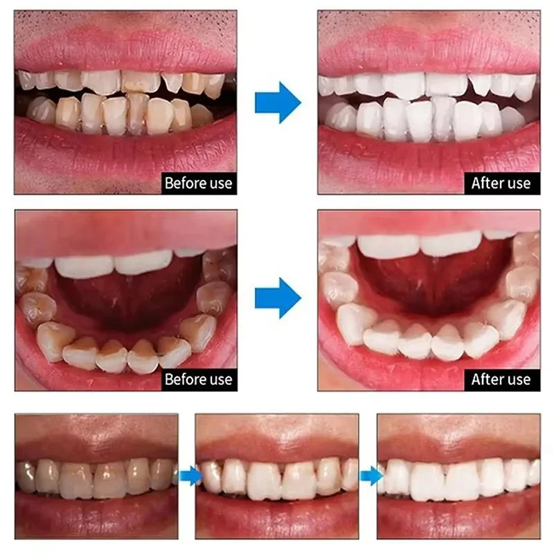5D Teeth Whitening Strips Gel