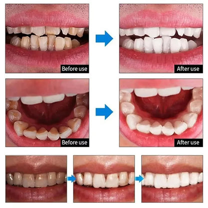 5D Teeth Whitening Strips Gel